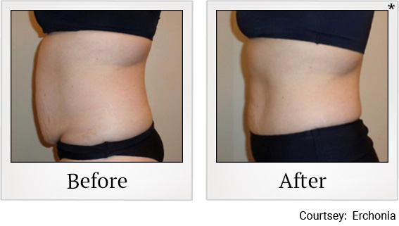 Before and After photos of Fat Reduction at Zerona Santa Rosa in Santa Rosa